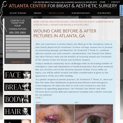 Wound Care Before & After Pictures Atlanta, Buckhead, ATL
