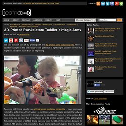 3D-Printed Exoskeleton: Toddler’s Magic Arms