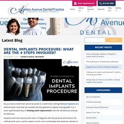 Dental Implant Procedure Step by Step - Missing Teeth Replacement