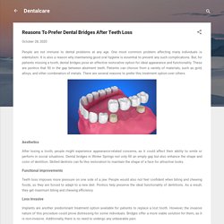 Reasons To Prefer Dental Bridges After Teeth Loss