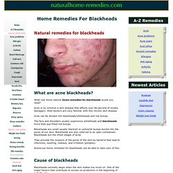 Home Remedies For Blackheads – Acne Treatment