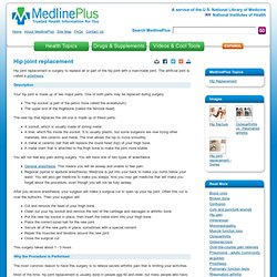 Hip joint replacement: MedlinePlus Medical Encyclopedia