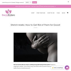 Stretch Marks: How to Get Rid of Them for Good!