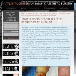 Hand Surgery Before & After Pictures Atlanta, Buckhead, ATL
