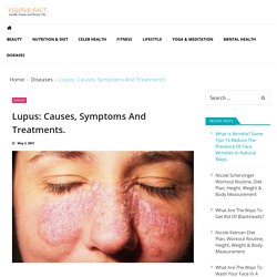 Lupus: Causes, Symptoms And Treatments. - Vigourfact