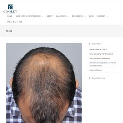 Are There Any Side Effects Of PRP For Hair Restoration?