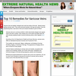 Top 10 Remedies for Varicose Veins