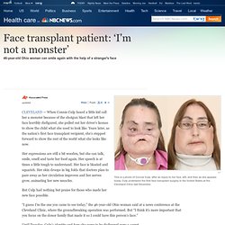 Face transplant patient: ‘I'm not a monster’ - Health - Health care - msnbc.com - (Build 20100722150226)