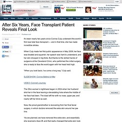 After Six Years, Face Transplant Patient Reveals Final Look - Incredible Health - FOXNews.com - (Build 20100722150226)