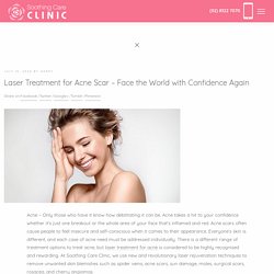 Laser Treatment for Acne Scar – Face the World with Confidence Again