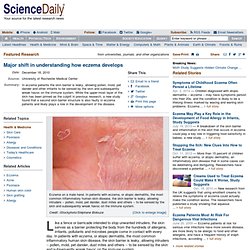 Major shift in understanding how eczema develops