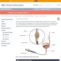 Ureteroscopy for kidney or ureteral stones – EAU Patient Information